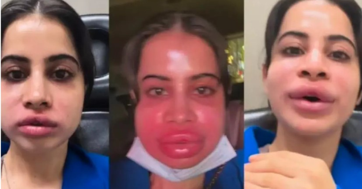 उर्फी जावेद: अमीरी, बिगड़ा चेहरा और सोशल मीडिया पर हंगामा – जानिए पूरी कहानी!